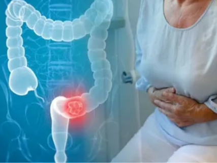 Colon & Rectal Cancer Screening